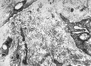M,9y. | IgA nephropathy M,9y. | IgA nephropathy